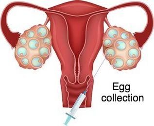 Egg retrieval and semen collection